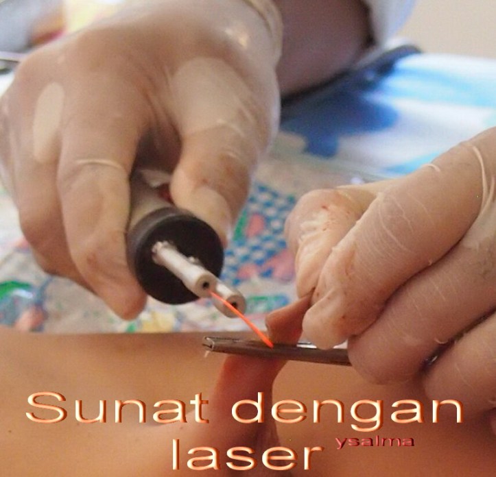 sunat-anak-lelaki-dengan-laser