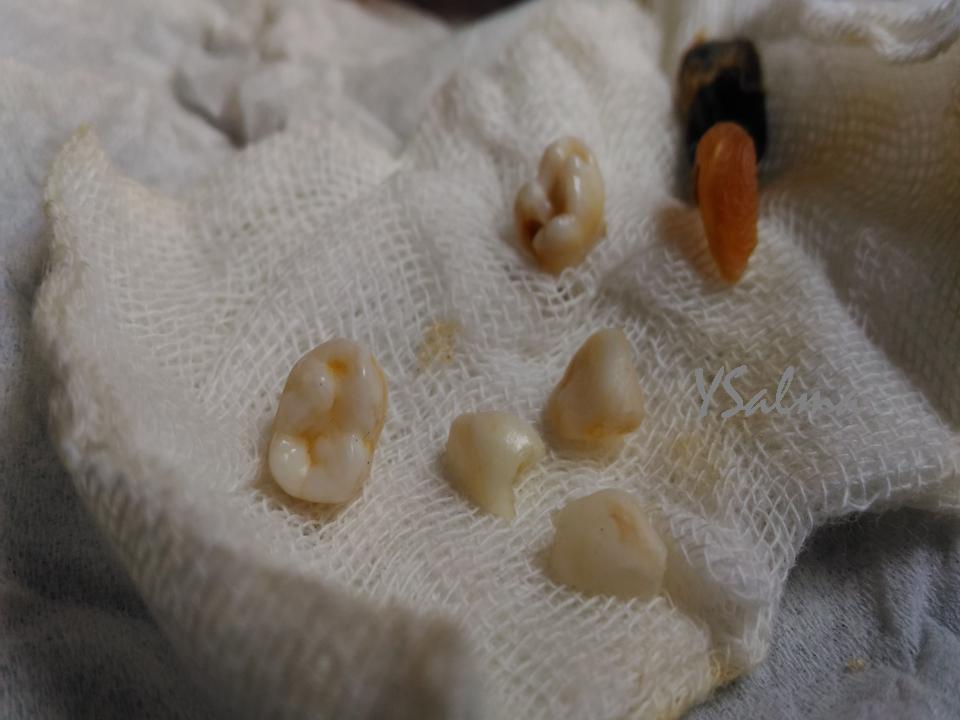 Gigi susu dan geraham bocah yang tersimpan