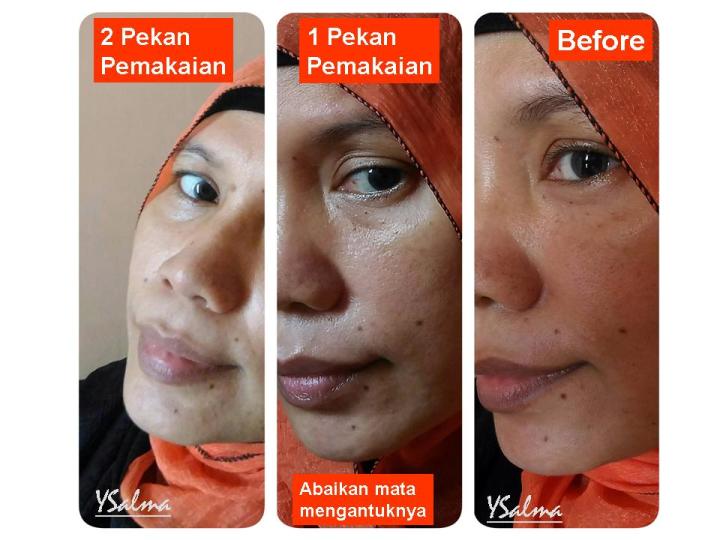 Skincare untuk menghilangkan bekas jerawat BASE Personalized Skincare foto before after